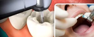 Dental implants in Austin