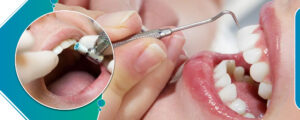 Affordable Clear Aligner Treatment